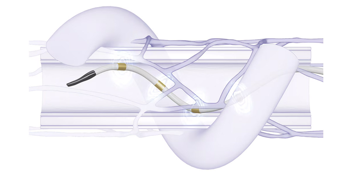 Renal Denervation